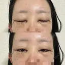 目頭切開 / クマ治療 / 目尻切開 / 下まぶたの脂肪取り / タレ目形成・グラマラスライン（切開） / タレ目形成・グラマラスライン（埋没） / ヒアルロン酸注入（涙袋） / ボトックス（エラ・小顔） Tokyo Tensei Clinic 銀座院 DAY 2 サムネイル用
