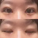 二重埋没 / 目頭切開 Olino美容外科・美容皮膚科 AFTER サムネイル用