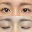 二重埋没 あじまビューティークリニック AFTER サムネイル用