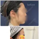 脂肪注入（額） S.T styleクリニック AFTER サムネイル用