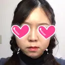 隆鼻術 / 鼻尖形成（切開） / 鼻中隔延長（切開） / 小鼻縮小（切開） ザ・プラス美容外科 DAY 149 サムネイル用