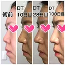 隆鼻術 / 鼻尖形成（切開） / 鼻中隔延長（切開） / 小鼻縮小（切開） ザ・プラス美容外科 DAY 149 サムネイル用