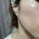 光治療（フォトフェイシャルなど） / ピーリング（ハリ・ツヤ） ミニマムスキンクリニック銀座 DAY 4 サムネイル用