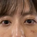 下まぶたの脂肪取り APOLLO BEAUTY CLINIC DAY 13 サムネイル用
