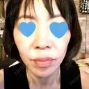 ボトックス（あご） / ボトックス（口角） / ボトックス（眉間） / ボトックス（目尻） / ボトックス（額） / ボトックス（人中） DMTC美容皮膚科 大宮院 DAY 8 サムネイル用
