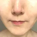 ボトックス（あご） / ヒアルロン酸注入（鼻翼基部） / その他（口元） ルラ美容クリニック 東京駅前院 DAY 9 サムネイル用
