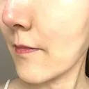 ボトックス（あご） / ヒアルロン酸注入（鼻翼基部） / その他（口元） ルラ美容クリニック 東京駅前院 DAY 9 サムネイル用