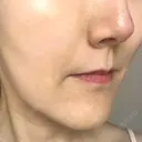 ボトックス（あご） / ヒアルロン酸注入（鼻翼基部） / その他（口元） ルラ美容クリニック 東京駅前院 DAY 9 サムネイル用