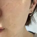 ピーリング（ニキビ・毛穴） Tokyo Tensei Clinic 銀座院 AFTER サムネイル用