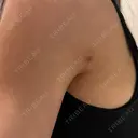 脂肪吸引（二の腕） 湘南美容クリニック 京都院 DAY 26 サムネイル用