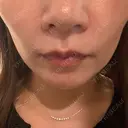 ヒアルロン酸注入（頬） 渋谷美容外科クリニック 渋谷院 AFTER サムネイル用