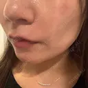 ヒアルロン酸注入（頬） 渋谷美容外科クリニック 渋谷院 DAY 6 サムネイル用