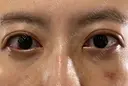 下まぶたの脂肪取り APOLLO BEAUTY CLINIC DAY 14 サムネイル用