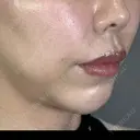 ヒアルロン酸注入（頬） アリエル美容クリニック 郡山院 AFTER サムネイル用