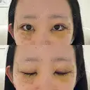 目頭切開 / クマ治療 / 目尻切開 / 下まぶたの脂肪取り / タレ目形成・グラマラスライン（切開） / タレ目形成・グラマラスライン（埋没） / ヒアルロン酸注入（涙袋） / ボトックス（エラ・小顔） Tokyo Tensei Clinic 銀座院 DAY 4 サムネイル用
