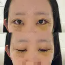 目頭切開 / クマ治療 / 目尻切開 / 下まぶたの脂肪取り / タレ目形成・グラマラスライン（切開） / タレ目形成・グラマラスライン（埋没） / ヒアルロン酸注入（涙袋） / ボトックス（エラ・小顔） Tokyo Tensei Clinic 銀座院 DAY 3 サムネイル用