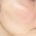 その他（肌） / ポテンツァ オラクル美容皮膚科 大阪梅田院 AFTER サムネイル用