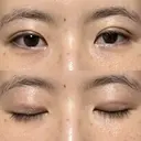 二重埋没 / その他（目元） 湘南美容クリニック 藤沢院 DAY 6 サムネイル用