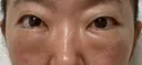 クマ治療 / 下まぶたたるみ取り / 下まぶたの脂肪取り / 脂肪注入（目の下） 湘南美容クリニック 千葉センシティ院 DAY 1 サムネイル用