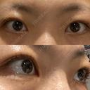 目頭切開 LUHO（ルホ）美容外科 DAY 94 サムネイル用