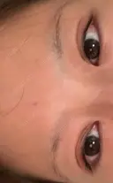 下まぶたの脂肪取り APOLLO BEAUTY CLINIC DAY 9 サムネイル用