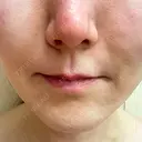 ボトックス（あご） / ヒアルロン酸注入（鼻翼基部） / その他（口元） ルラ美容クリニック 東京駅前院 DAY 13 サムネイル用