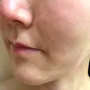 ボトックス（あご） / ヒアルロン酸注入（鼻翼基部） / その他（口元） ルラ美容クリニック 東京駅前院 DAY 13 サムネイル用