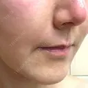 ボトックス（あご） / ヒアルロン酸注入（鼻翼基部） / その他（口元） ルラ美容クリニック 東京駅前院 DAY 13 サムネイル用