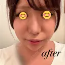 ヒアルロン酸注入（鼻） / ヒアルロン酸注入（あご） / 美容点滴・美容注射（疲労回復） HAAB×DREAM BEAUTY CLINIC 大阪梅田院 DAY 0 サムネイル用