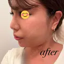 ヒアルロン酸注入（鼻） / ヒアルロン酸注入（あご） / 美容点滴・美容注射（疲労回復） HAAB×DREAM BEAUTY CLINIC 大阪梅田院 DAY 0 サムネイル用