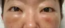 クマ治療 / 下まぶたたるみ取り / 下まぶたの脂肪取り / 脂肪注入（目の下） 湘南美容クリニック 千葉センシティ院 DAY 2 サムネイル用