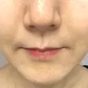 ボトックス（あご） / ヒアルロン酸注入（鼻翼基部） / その他（口元） ルラ美容クリニック 東京駅前院 AFTER サムネイル用
