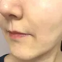 ボトックス（あご） / ヒアルロン酸注入（鼻翼基部） / その他（口元） ルラ美容クリニック 東京駅前院 DAY 14 サムネイル用