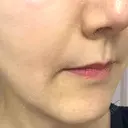 ボトックス（あご） / ヒアルロン酸注入（鼻翼基部） / その他（口元） ルラ美容クリニック 東京駅前院 DAY 14 サムネイル用