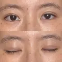 二重埋没 / その他（目元） 湘南美容クリニック 藤沢院 DAY 7 サムネイル用