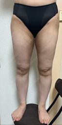 脂肪吸引（脚） / 脂肪吸引（お尻） 湘南美容クリニック 京都院 AFTER サムネイル用