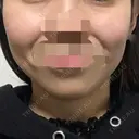 脂肪溶解注射（顔） ヴェリテクリニック 名古屋院 DAY 30 サムネイル用