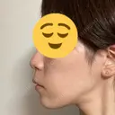 ボトックス（あご） / ヒアルロン酸注入（あご） / ヒアルロン酸注入（唇） KAGA CLINIC AFTER サムネイル用
