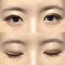 二重埋没 / その他（目元） 湘南美容クリニック 藤沢院 DAY 8 サムネイル用