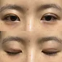 二重埋没 / その他（目元） 湘南美容クリニック 藤沢院 DAY 9 サムネイル用