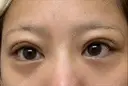 下まぶたの脂肪取り APOLLO BEAUTY CLINIC DAY 12 サムネイル用