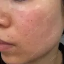 エレクトロポレーション / フォトシルクプラス もとび美容外科クリニック 新宿院 AFTER サムネイル用