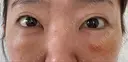 クマ治療 / 下まぶたたるみ取り / 下まぶたの脂肪取り / 脂肪注入（目の下） 湘南美容クリニック 千葉センシティ院 DAY 4 サムネイル用