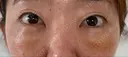 クマ治療 / 下まぶたたるみ取り / 下まぶたの脂肪取り / 脂肪注入（目の下） 湘南美容クリニック 千葉センシティ院 DAY 5 サムネイル用