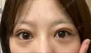 下まぶたの脂肪取り APOLLO BEAUTY CLINIC DAY 13 サムネイル用