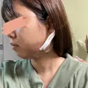 脂肪吸引（顔） R Beauty CLINIC 名古屋院 DAY 1 サムネイル用