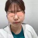 脂肪吸引（顔） R Beauty CLINIC 名古屋院 DAY 35 サムネイル用
