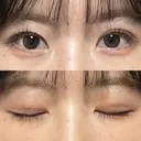 二重埋没 / その他（目元） 湘南美容クリニック 藤沢院 DAY 10 サムネイル用