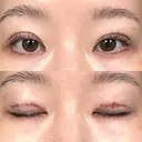 二重埋没 / ボトックス（エラ・小顔） / ボトックス（肩） THE FIRST CLINIC 多摩センター院 DAY 0 サムネイル用
