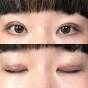 二重埋没 / ボトックス（エラ・小顔） / ボトックス（肩） THE FIRST CLINIC 多摩センター院 DAY 1 サムネイル用